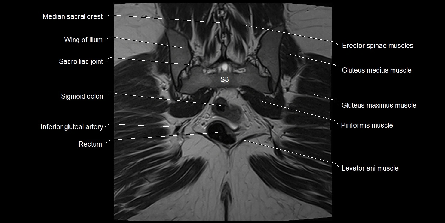 female pelvis coronal cross sectional anatomy image 30.webp